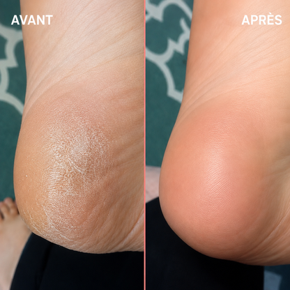 Râpe électrique anti-callosités